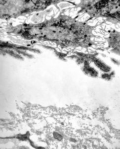 M, 22y. | epidermolysis bullosa - junctional type, uncompletely separated basement membrane M, 22y. | epidermolysis bullosa - junctional type, uncompletely separated basement membrane